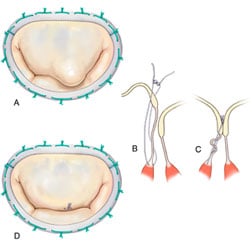 Artificial chordoplasty