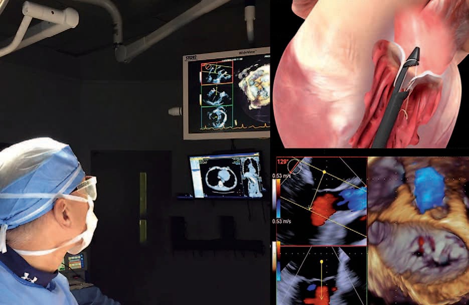 In November 2016, David H. Adams, MD, performed the first NeoChord procedure in the United States, in a trial exploring the efficacy of beating-heart mitral valve repair, without the use of cardiopulmonary bypass, through a minithoracotomy.