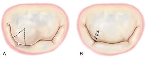 Anterior leaflet triangular resection