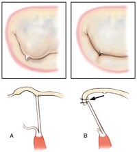 Chordal Transfer