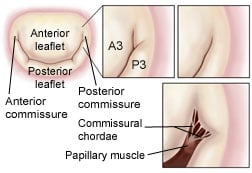 Mitral Commissures