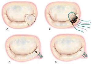 Quadrangular resection and annular plication