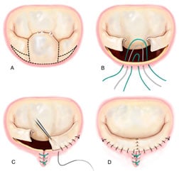 Quadrangular resection