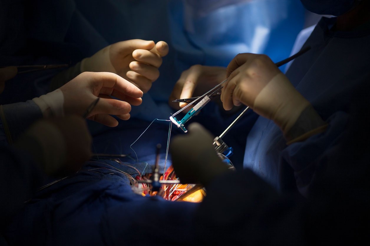 An annuloplasty ring is sewn into the heart during mitral valve surgery to stabilize the repair.