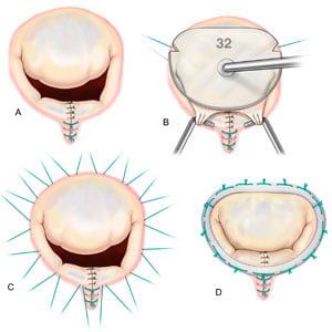 Annular Remodeling