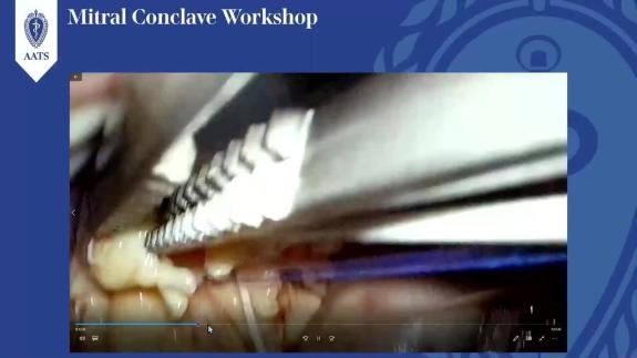 Screen capture of the video David H. Adams: Advanced Mitral Valve Repair Interactive Video Session