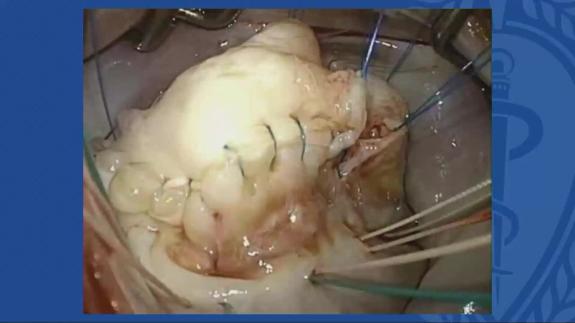 Screen capture of the video Ahmed El-Eshmawi: Techniques in Mitral Annular Calcification