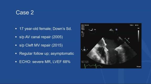 Screen capture of the video David H. Adams: Mitral Clefts in Adults