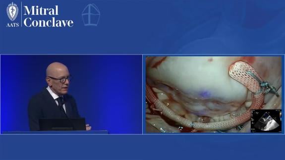 Screen capture of the video David Adams - Mitral Regurgitation without Obvious Triggers for Intervention