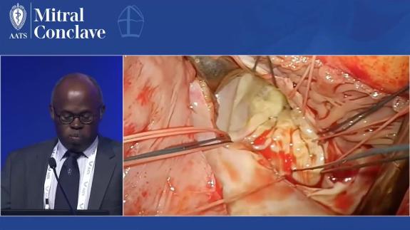 Screen capture of the video Anelechi Anyanwu - Left Ventricle Aneurysmectomy with Mitral Valve Repair