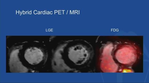 Screen capture of the video David Adams - Roundtable III Arrhythmogenic Mitral Valve Prolapse