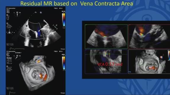 Screen capture of the video Stamatios Lerakis - Assessment of Procedural Outcome after Transcatheter Valve Repair or Replacement