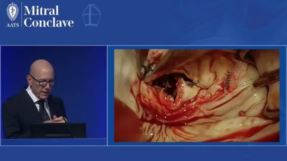 Screen capture of the video David Adams - Re-repair with Limited Tissue
