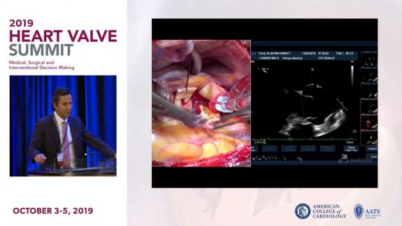 Screen capture of the video 2019 Heart Valve Summit- Case of Aortic Valve Sparing