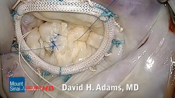 Screen capture of the video Mitral Valve Repair of Posterior Leaflet Prolapse