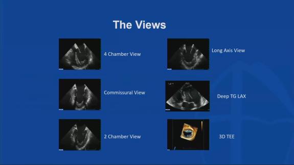 Screen capture of the video Menachem Weiner - Assessment of Procedural Outcome after Surgical Valve Repair