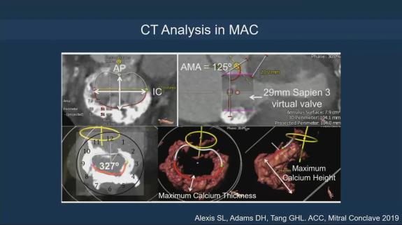 Screen capture of the video Gilbert Tang - CT and Fluoroscopy Imaging of the Mitral and Tricuspid Valve for Screening and Procedural Guidance the ABCs
