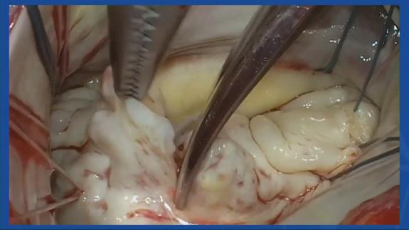 Screen capture of the video David Adams - Leaflet Resection