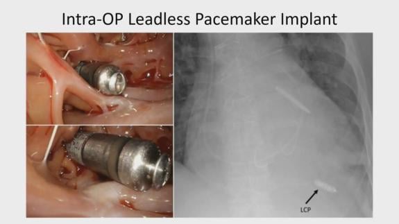 Screen capture of the video Marc Miller - When to Consider Leadless Pacemakers and Permanent Epicardial Leads During Mitral or Tricuspid Valve Surgery