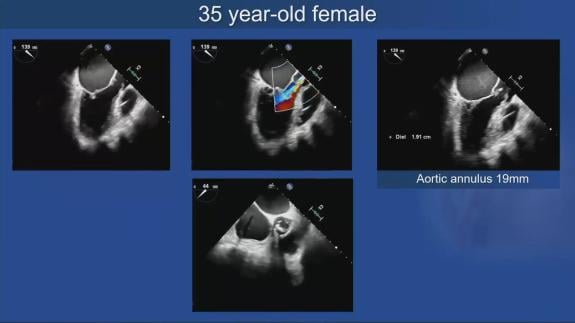 Screen capture of the video Ismail El-Hamamsy - Concomitant Aortic and Mitral Case Based Learning