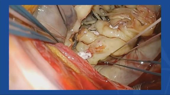 Screen capture of the video Erick Sun - Modified Anterior Leaflet Flip Technique for Mitral Valve Replacement in Extensive Mitral Annular Calcification