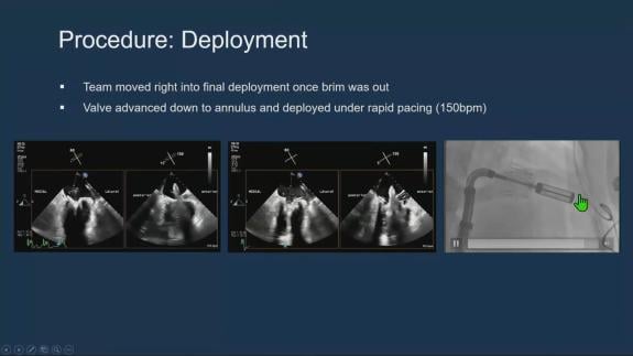Screen capture of the video Gilbert Tang - Case in a Box - Transcatheter Mitral Valve Replacement