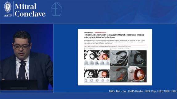 Screen capture of the video Dimosthenis Pandis - Arrhythmogenic Mitral Valve Prolapse – Theory