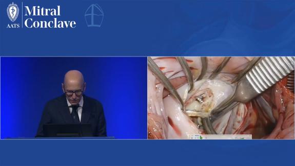 Screen capture of the video David Adams - Interactive Long Videos - Reoperations