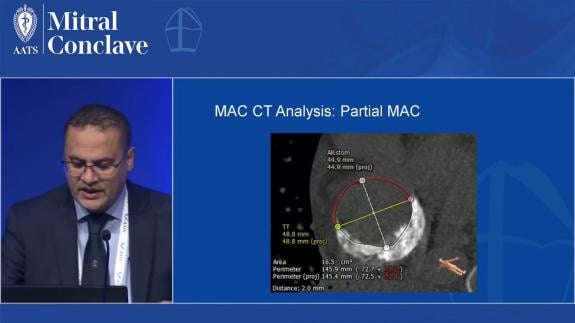 Screen capture of the video Ahmed El-Eshmawi - Modified Anterior Leaflet Flip Technique for Mitral Valve Replacement in Extensive Mitral Annular Calcification