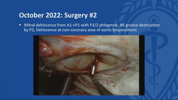 Screen capture of the video Sophia Alexis - Recurrent Valve Dehiscence After Aortic and Mitral Valve Replacement