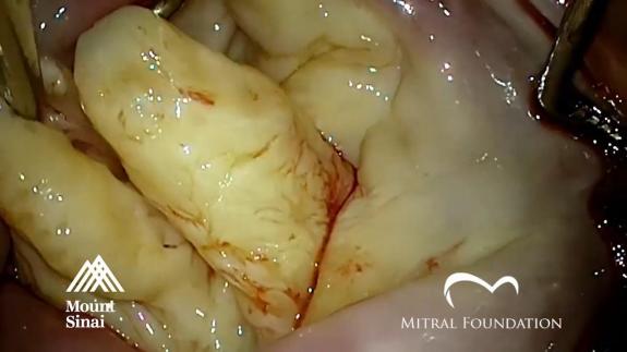 Screen capture of the video Repair of Multi-segment Barlow&#039;s Mitral Valve Disease