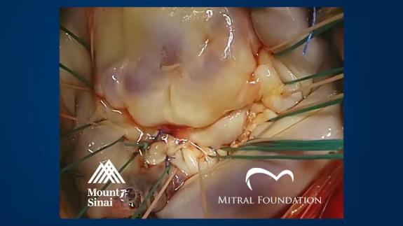 Screen capture of the video Mitral Valve Repair with Sliding Leaflet Plasty and Annular Plication