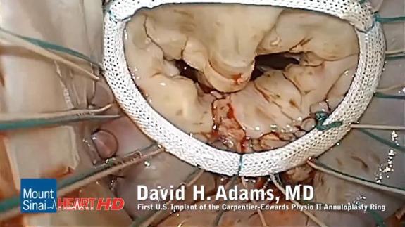 Screen capture of the video First U.S. Implant of the Carpentier-Edwards Physio II Annuloplasty Ring