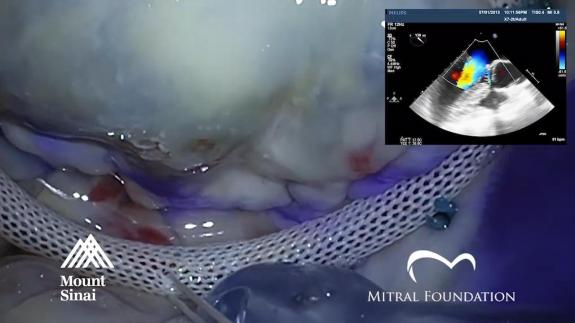 Screen capture of the video Systolic Anterior Motion After Mitral Valve Repair