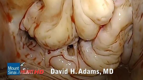 Screen capture of the video Mitral Valve Repair of Complex Barlow&#039;s Disease