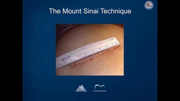 Screen capture of the video ACS Video Atlas on Minimally Invasive Mitral Valve Surgery