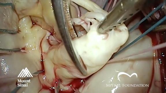 Screen capture of the video Mitral Valve Repair for Posterior Middle Segment Prolapse: Triangular Resection