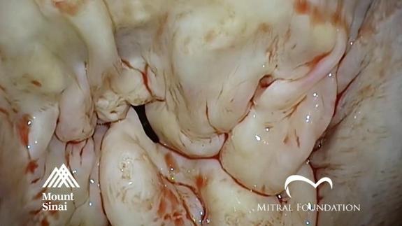 Screen capture of the video Barlow&#039;s Disease: Mitral Valve Repair with Limited De-calcification