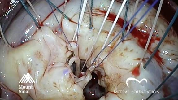 Screen capture of the video Anterior Leaflet Mitral Valve Repair: Chordal Transposition and Neochordoplasty