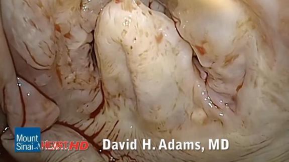 Screen capture of the video Mitral Valve Repair of Fibroelastic Deficiency with Ruptured Chordae and P2 Prolapse