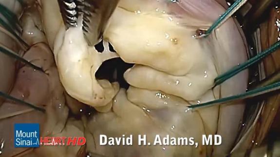 Screen capture of the video Mitral Valve Repair of Commisural Prolapse