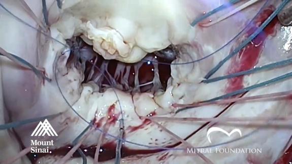 Screen capture of the video Mitral Valve Repair of Anterior Leaflet Perforation in Healed Endocarditis