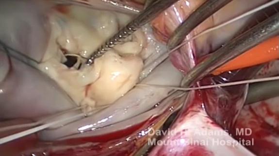Screen capture of the video Mitral Valve Repair of Fibroelastic Deficiency with Posterior Leaflet Prolapse