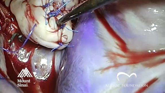 Screen capture of the video Residual Mitral Regurgitation After Mitral Valve Repair: Leaflet Perforation