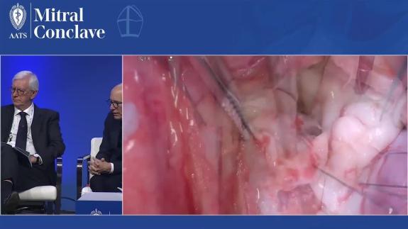Screen capture of the video Ismail El-Hamamsy - Aortic Root Surgery with Mitral Valve Repair