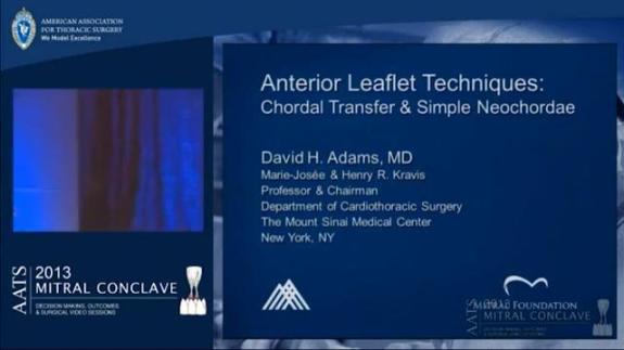 Screen capture of the video David H. Adams: Anterior Leaflet: Chordal Transfer/Simple Neochordae