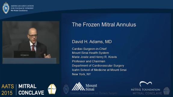 Screen capture of the video David H. Adams: The Frozen Mitral Annulus