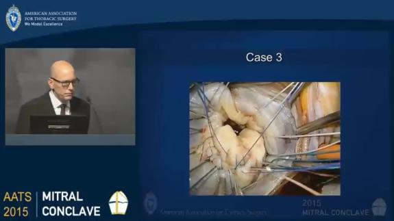 Screen capture of the video David H. Adams: Posterior Leaflet Prolapse: Leaflet Detachment