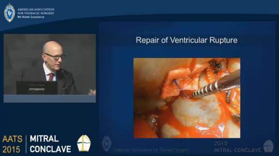 Screen capture of the video David H. Adams: Dealing with Ventricular Rupture After Mitral Valve Surgery