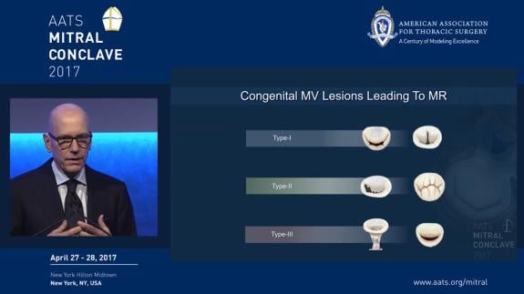Screen capture of the video David H. Adams: Congenital Mitral Valve Disease